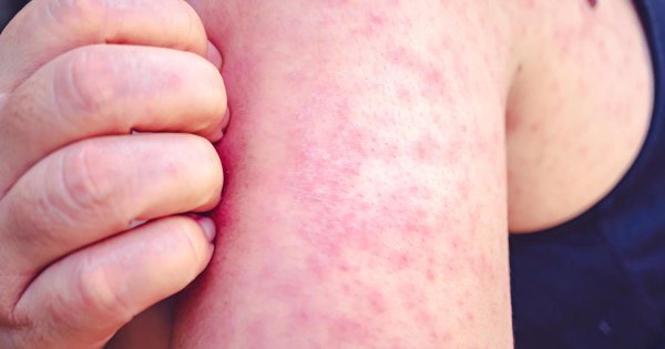 Measles cases rose 79% globally last year, WHO says. Experts explain why.
