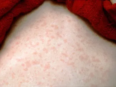 Could U.S. Measles Cases Break a Record This Year? What to Know