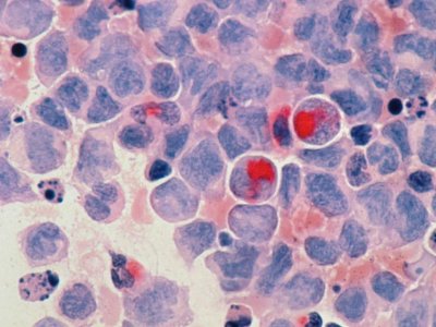 Dietary selenium may help fight acute myeloid leukemia, researchers report | Penn State University