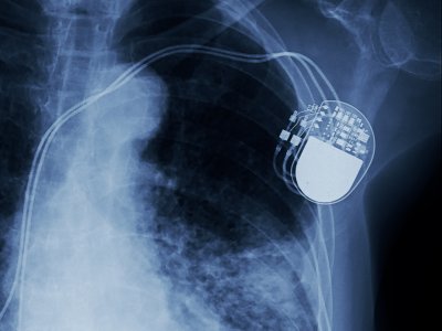 Dual-energy device unlocks potential for wireless medical implants - Interesting Engineering